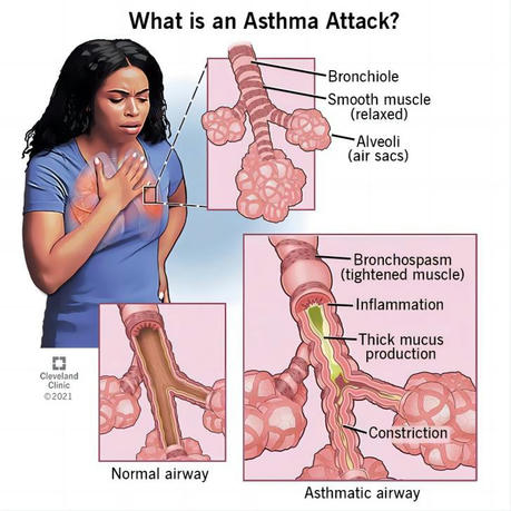 Asthma: Causes and Prevention Measures