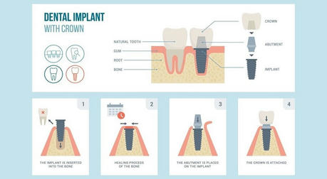 Dental Implants: The Choice for Restoring Your Smile