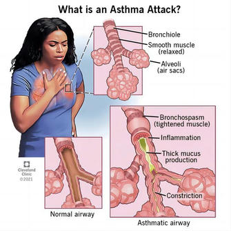 Asthma: Causes and Prevention Measures